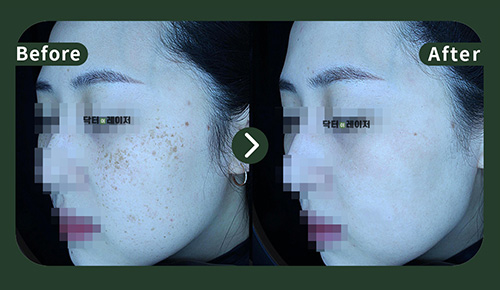 [주근깨] 30대 젼후사진