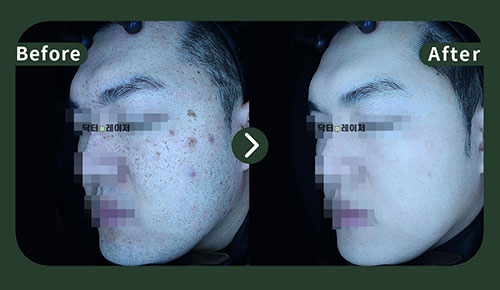 잡티] 30대 전후사진