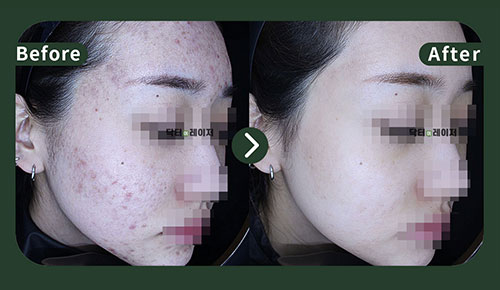 [여드름] 20대 전후사진