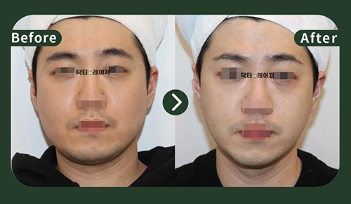 [리프팅] 30대 전후사진