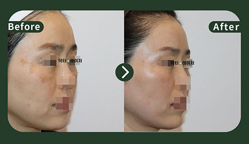 [기미/리프팅] 50대 전후사진