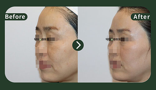 [기미/리프팅] 50대 전후사진