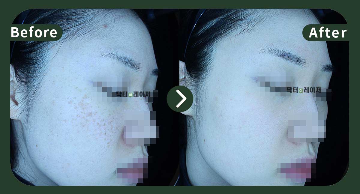 [잡티+주근깨] 30대 전후사진